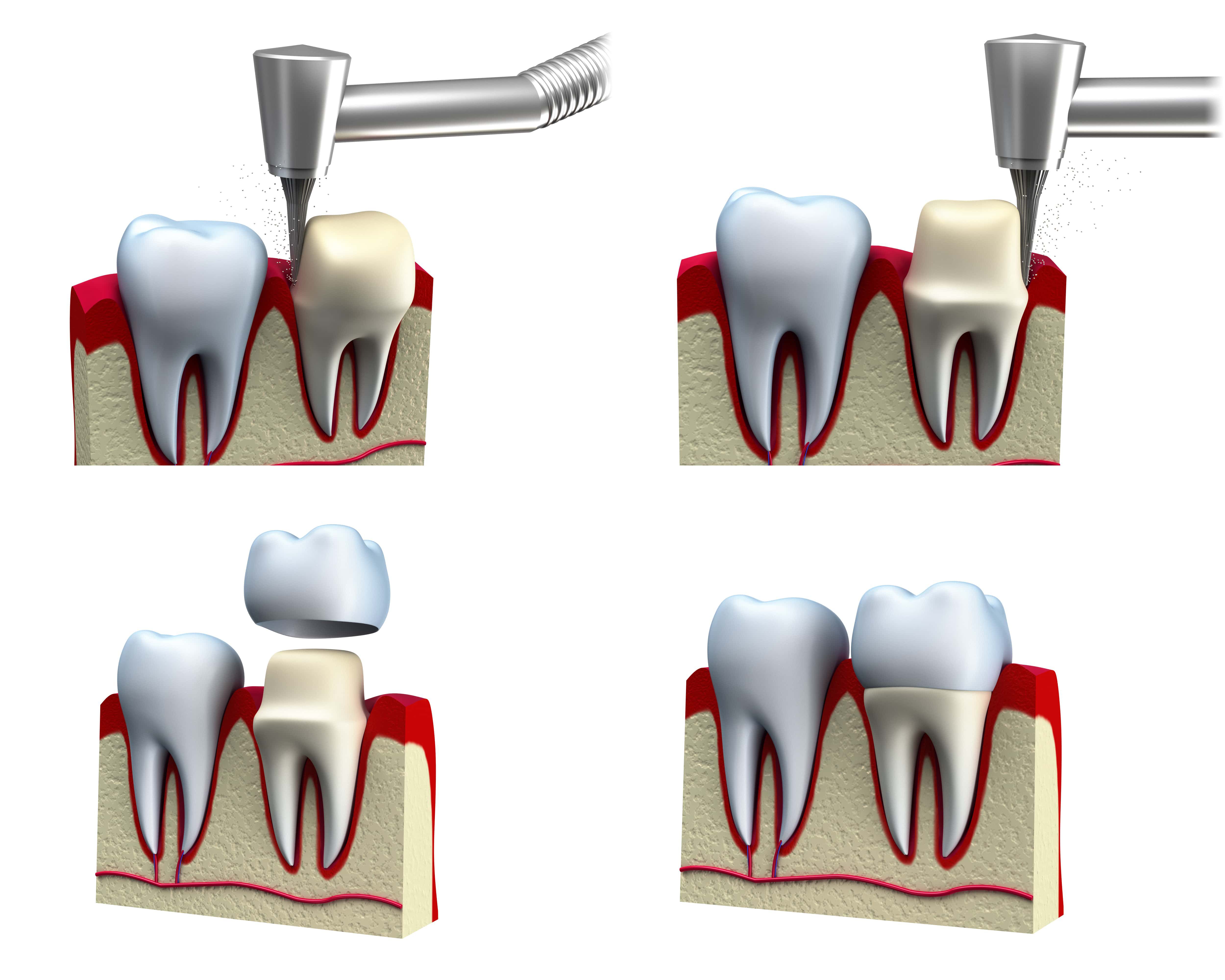 The process of preparing a tooth for a dental crown shown in four steps