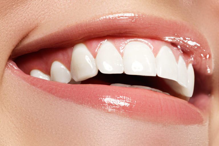 Teeth Whitening after treatment
