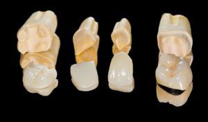 Dental Restorations