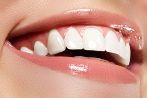 Flawless Smile