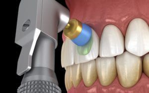 Computerized image of teeth cleaning