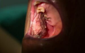 Man with oral cancer